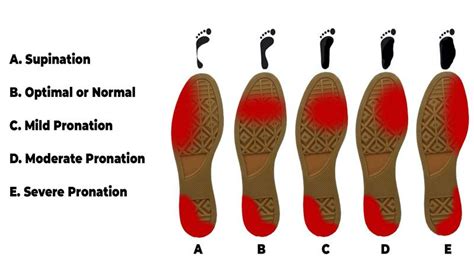 supination vs underpronation.